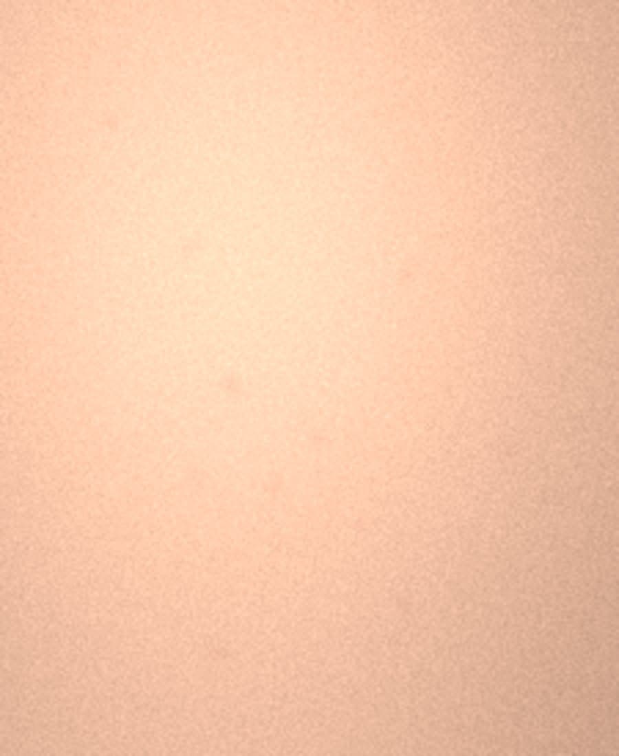 ব্রণের দাগ: ৪টি পিল সেশন: পরে